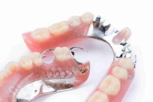 Removal Prosthesis Treatment at Aghbashian Dental