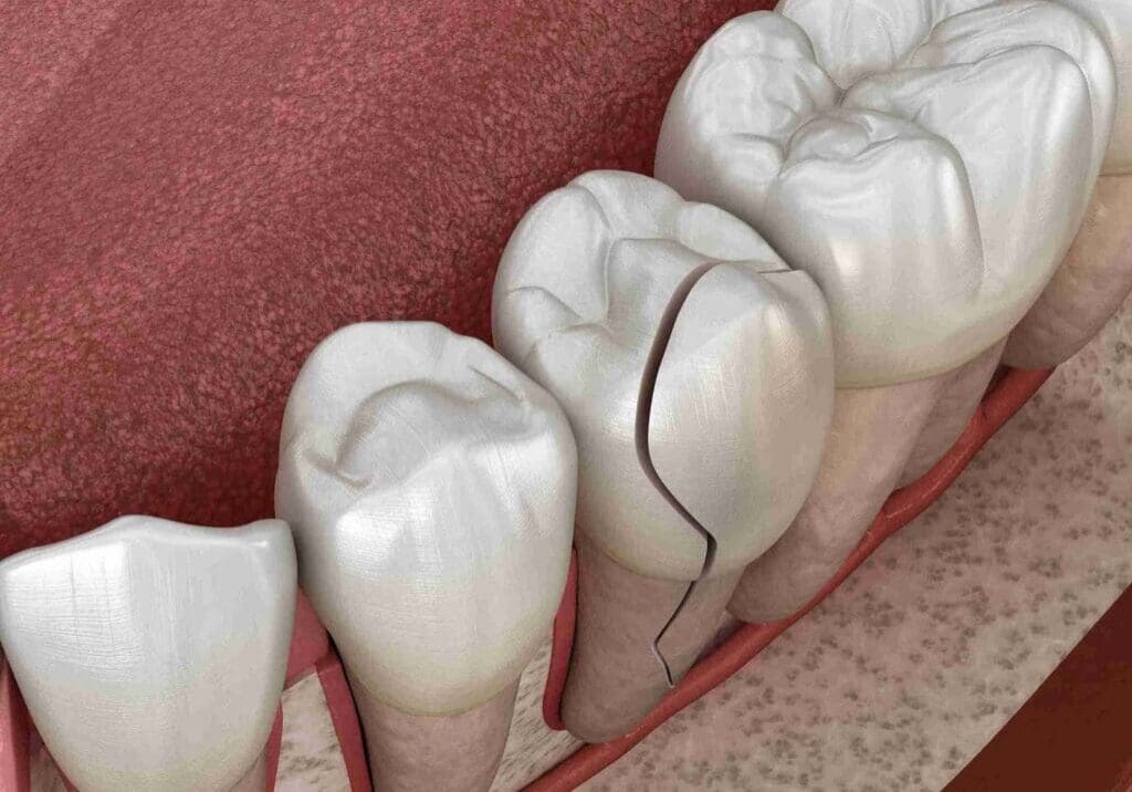 Close-up of a cracked tooth being restored with a high-tech dental crown at Aghbashian Dental in Glendale, CA.